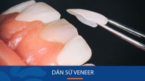Dán sứ Veneer – Lớp mặt nạ hoàn hảo cho hàm răng trắng sáng