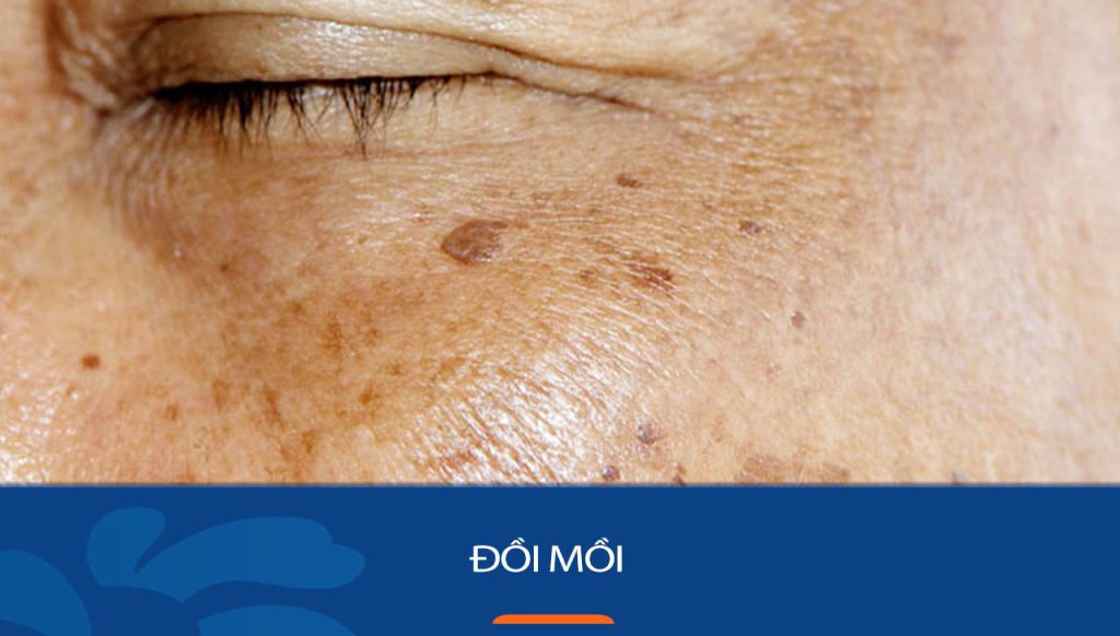 Đồi Mồi: 6 Nguyên nhân & 6 Cách điều trị hiệu quả