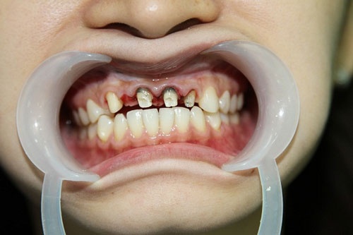 hàn răng trẻ em 