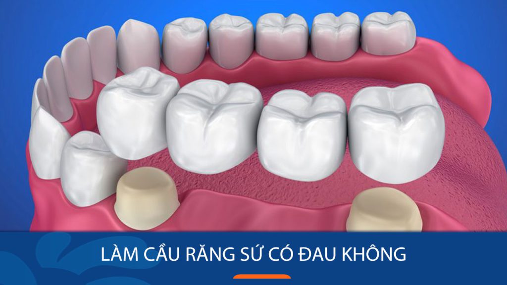 Làm cầu răng sứ có Đau không? Bao lâu thì hết Đau