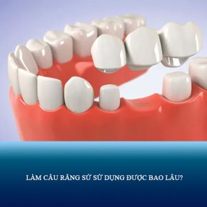 Làm cầu răng sứ sử dụng được bao lâu? Cách làm tăng tuổi thọ răng sứ!