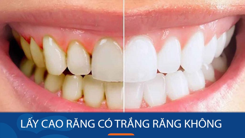 Lấy cao răng có trắng răng không? Bác sỹ Kangnam