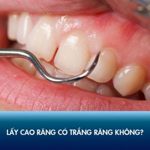 Lấy cao răng có trắng răng không? Bác sỹ Kangnam làm rõ