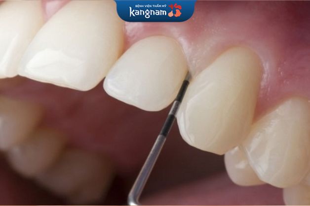 Việc mài răng nhiều hay ít tùy thuộc vào công nghệ bọc sứ của từng nha khoa