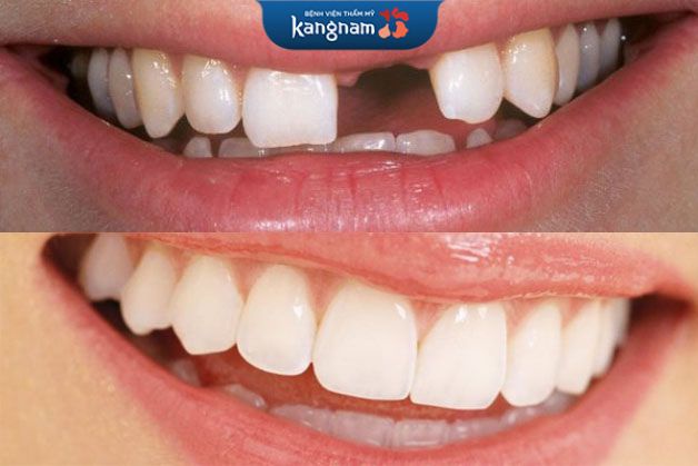Làm cầu răng sứ khắc phục tình trạng mất 1 răng cửa