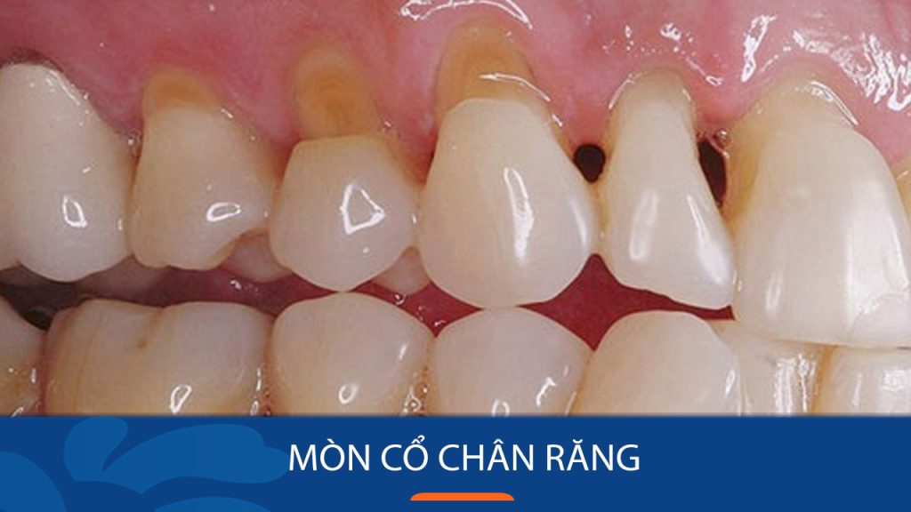 Mòn cổ chân răng: Nguyên nhân và cách điều trị tận gốc