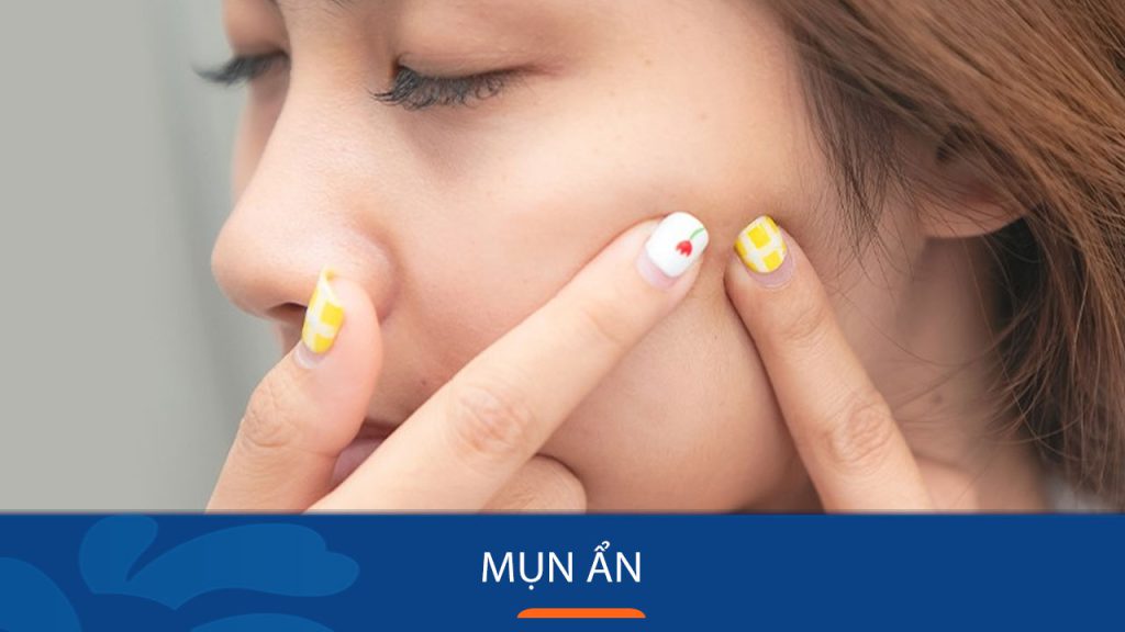 Bí quyết đánh bay mụn ẩn tận gốc, trả lại làn da mịn màng!