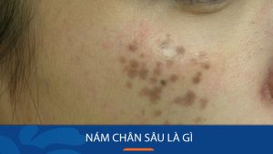 Nám chân sâu là gì? Các cách đẩy lùi nám chân sâu triệt để