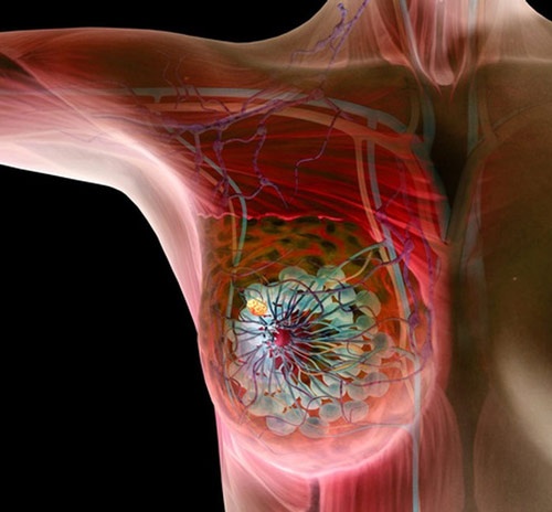 nhổ lông nách bị ung thư