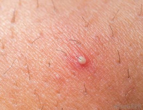 nhổ lông nách đúng cách