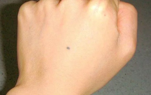 nốt ruồi son trên mu bàn tay