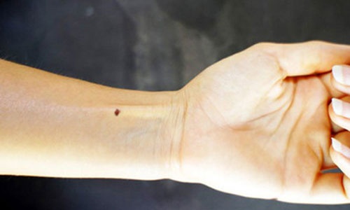 nốt ruồi trên cánh tay phải phụ nữ