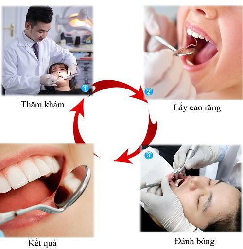 quy trình lấy cao răng