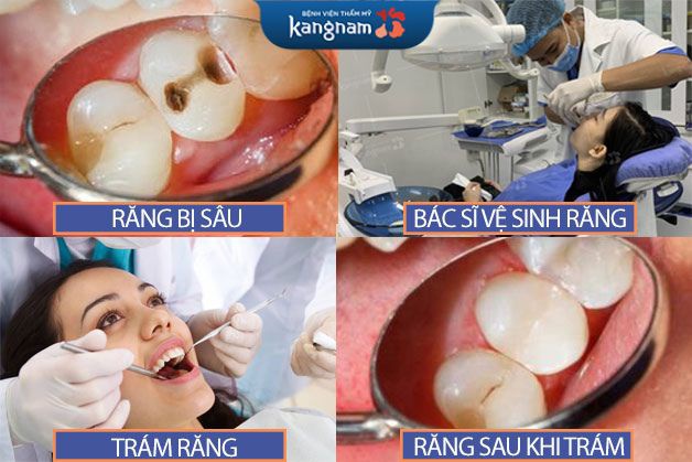 4 bước Quy trình trám răng thẩm mỹ an toàn chuẩn Hàn