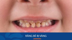 Răng bé bị vàng: Nguyên nhân và cách làm trắng răng