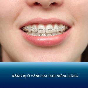 Nguyên nhân và cách khắc phục răng bị ố vàng khi niềng răng