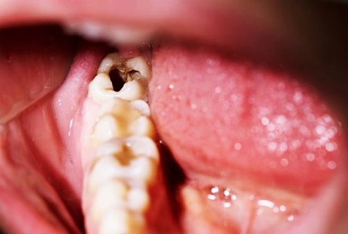 Răng khôn bị sâu có trám được không? Nên trám răng hay nhổ?
