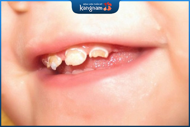 Đau buốt, sâu răng, sưng nướu là tác hại do do răng miệng không vệ sinh sạch, ố vàng bám dính
