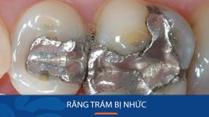 Răng trám bị nhức: Nguyên nhân và cách trị nhức răng sau