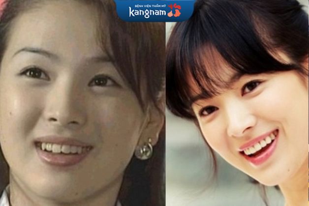 Vợ cũ Song Joong Ki - diễn viên Song Hye Kyo sở hữu nụ cười tỏa nắng hơn với hàm răng sứ đều đặn