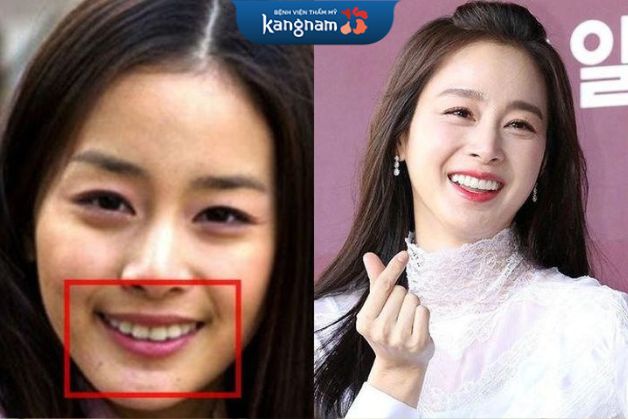 Quốc bảo nhan sắc Kim Tae Hee cũng nhờ đến gắn răng sứ để hoàn thiện vẻ ngoài vạn người mê