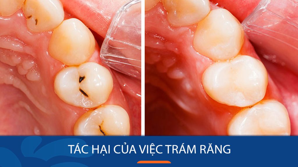 [KIẾN THỨC CẦN BIẾT] Tác hại của việc trám răng nhiều lần!