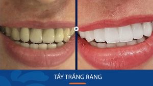 Tẩy trắng răng – Tạm biệt ố vàng, xỉn màu – Răng trắng sáng