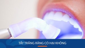 Tẩy trắng răng có hại không? Có ảnh hưởng đến ngà răng không