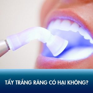 Tẩy trắng răng có hại không? Có ảnh hưởng đến ngà răng sau này không?