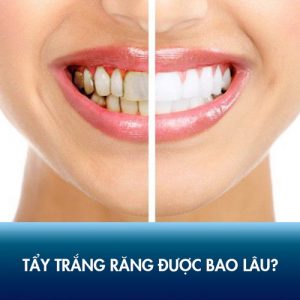 Tẩy trắng răng được bao lâu? Chăm sóc để màu răng bền nhất?
