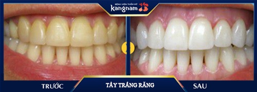 tẩy trắng răng kangnam