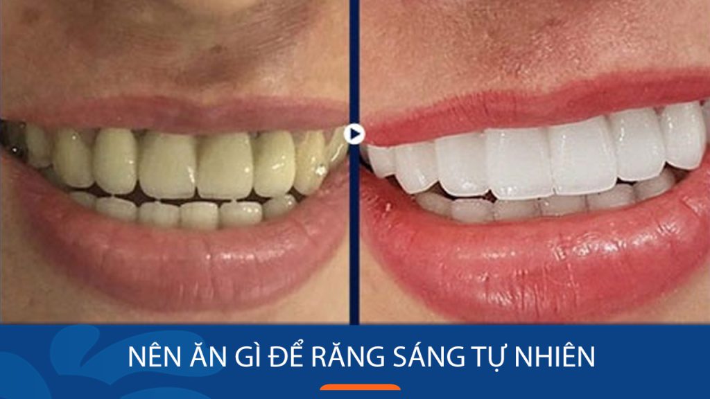Sau khi tẩy trắng răng Kiêng & Nên ăn gì để răng sáng tự nhiên