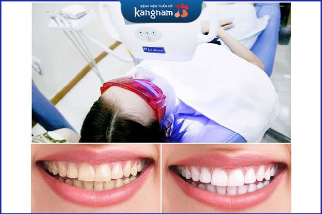 Tẩy trắng răng hiệu quả cao tại nha khoa