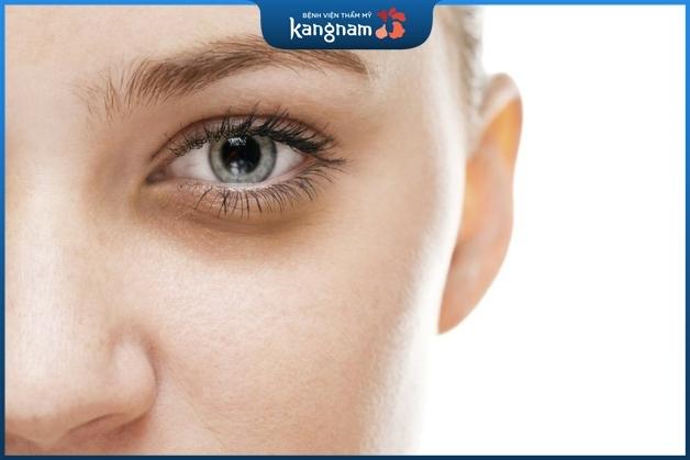 Thâm mắt có thể là do kết quả của di truyền