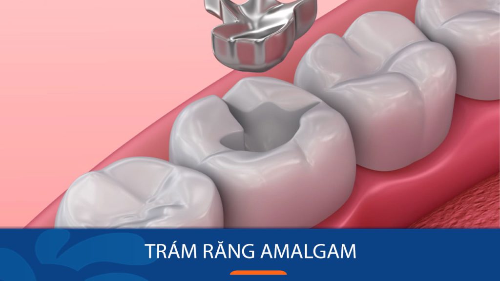 Amalgam là gì? Có nên trám răng bằng chất liệu Amalgam?