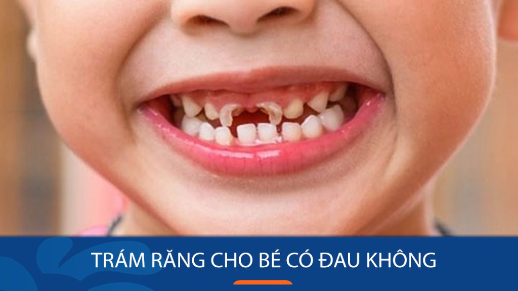 Trám răng cho bé có đau không? Nên trám răng cho bé