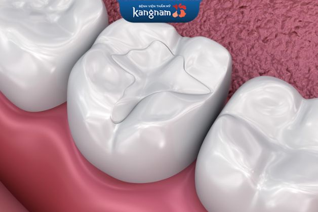 Răng đẹp tự nhiên với vật liệu trám răng Composite