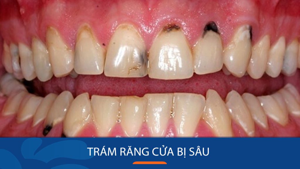 Nên trám răng cửa bị sâu hay thực hiện bọc sứ? bác sĩ giải đáp