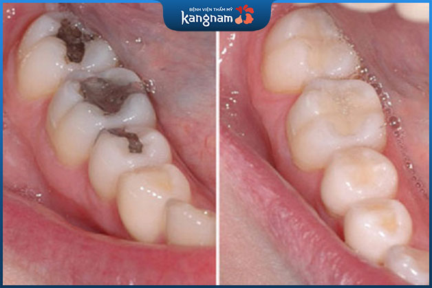 Hình ảnh trước và sau khi trám răng sâu tại Kangnam