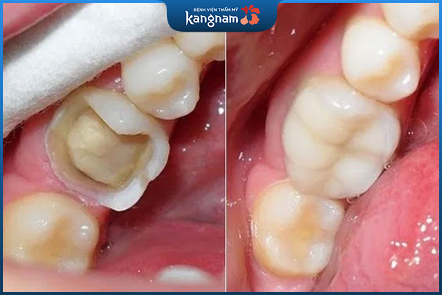 Trám răng tự nhiên trùng vs màu răng thật