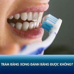 Trám răng xong có đánh răng được không? Cách chăm sóc răng