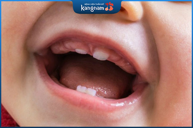 Trẻ 11 tháng cũng có thể bị vàng răng nếu không chăm sóc đúng cách 