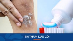 10+ Cách trị thâm đầu gối và khuỷu tay hiệu quả nhanh