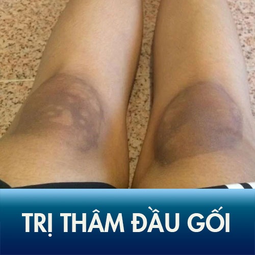 10+ Cách trị thâm Đầu gối, Khuỷu tay hiệu quả nhanh tại nhà