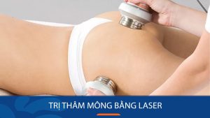 Trị thâm mông bằng laser – Tạm biệt vòng 3 THÂM TÍM – SẦN SÙI!