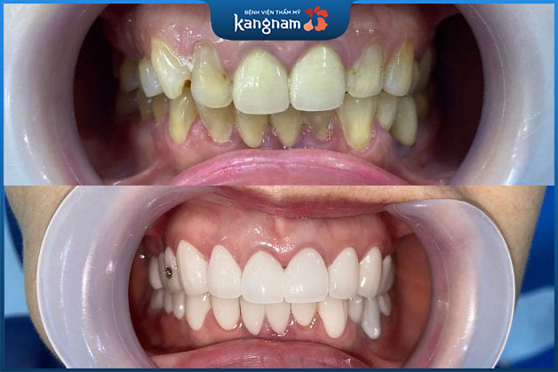 Răng cũ vàng ố đã được thay bằng hàm răng trắng sáng bật tông