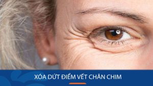 Cách xóa vết chân chim tại nhà đơn giản và hiệu quả