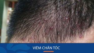 Vén màn bí mật về VIÊM CHÂN TÓC: Nguyên nhân, triệu chứng và GIẢI PHÁP ĐIỀU TRỊ HIỆU QUẢ