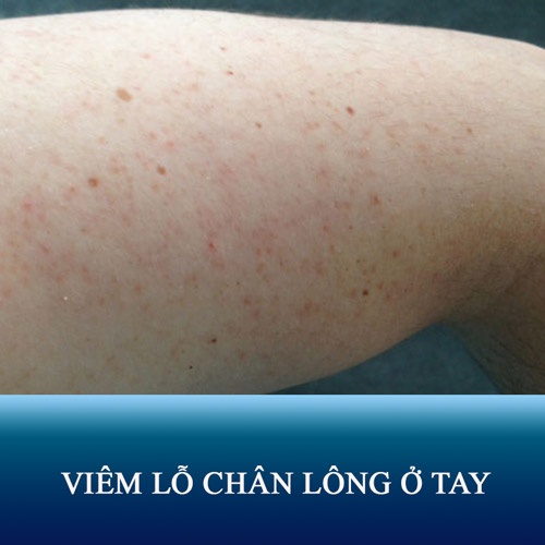 7 cách trị viêm lỗ chân lông ở tay Nhanh - Đơn giản - Hiệu quả