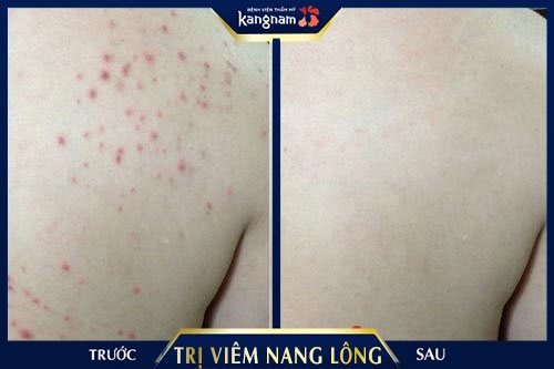 cách trị viêm nang lông ở vùng kí